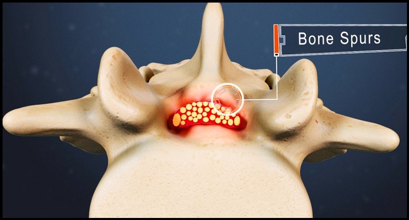 Lumbar Canal Stenosis Treatment in Kandivali